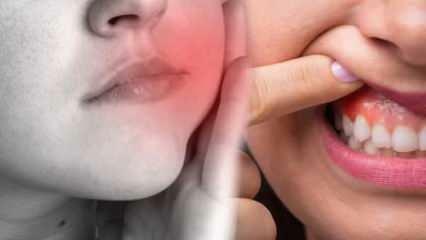 Kaj povzroča zobni absces? Kakšni so simptomi in v koliko dneh? Naravne rešitve za zobni absces...