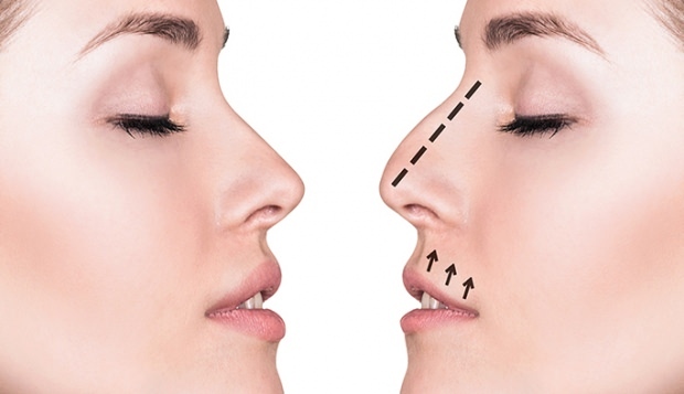 Kako poteka operacija nosu? V katerih primerih se izvaja operacija rinoplastike?