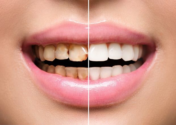 Kot posledica nezdrave prehrane pride do razbarvanja zob in izgube zob