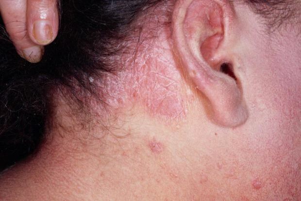 Kakšni so simptomi seboroičnega dermatitisa in kdo se pojavi? Živila, ki sprožijo bolezen