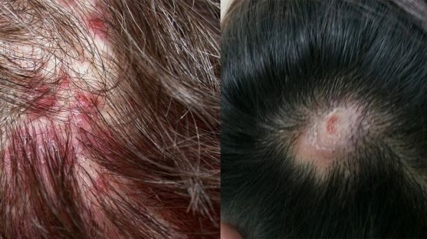 Zakaj se akne pojavijo na lasišču? Kako mozolji prehajajo na lasišče?