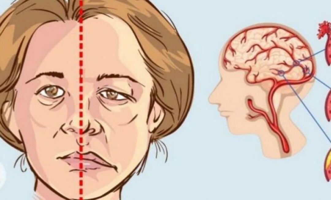 Kaj je možganska kap? Kakšni so simptomi možganske kapi? Kako preprečiti možgansko kap?