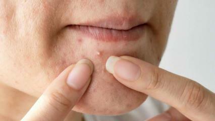 Zakaj se akne pojavijo na bradi? Naravna raztopina za akne na bradi