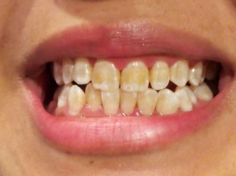 zobna slika osebe, katere zobje začnejo temniti