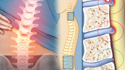 Kaj je zoženje hrbtenjače? Kakšni so simptomi zoženja hrbtenjače? Ali obstaja zdravilo za zoženje hrbtenjače?