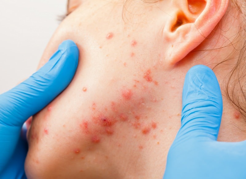virus povzroča pretisne omote na površini kože
