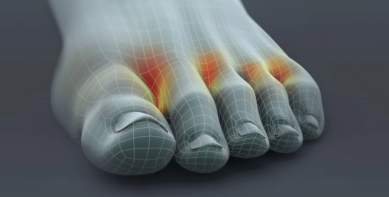 najpogostejša gliva na nogah je med prsti