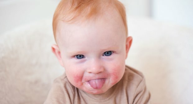 Pozor pri dojenčkih z rdečimi ličnicami! Sindrom lupljenih ličnic in njegovi simptomi