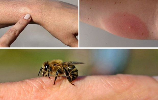 simptomi čebeljih alergij