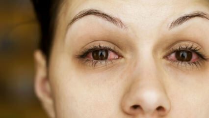 Kaj je konjunktivitis (očesna gripa) in kakšni so simptomi? Kako se prenaša konjuktivitis?