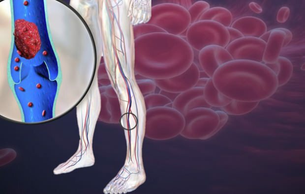 zmanjšan krvni obtok v venah nog povzroča bolečino